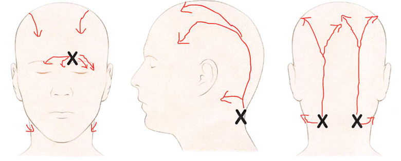 What Is Migraine Surgery Migraine Surgery Society